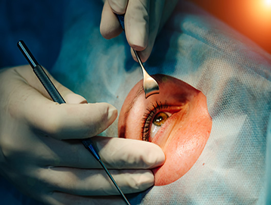 Laser Eye Surgery