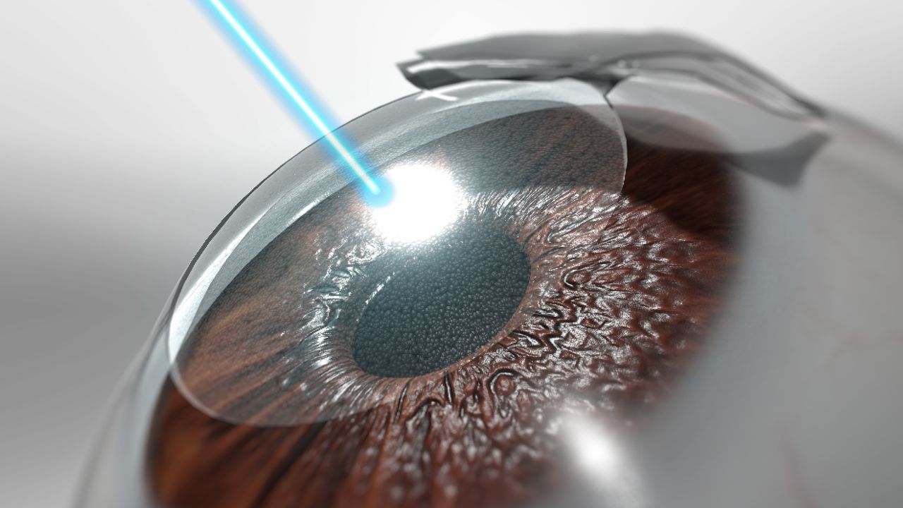 Specs Removal / LASIK