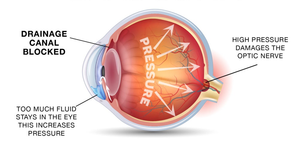 Glaucoma Treatment